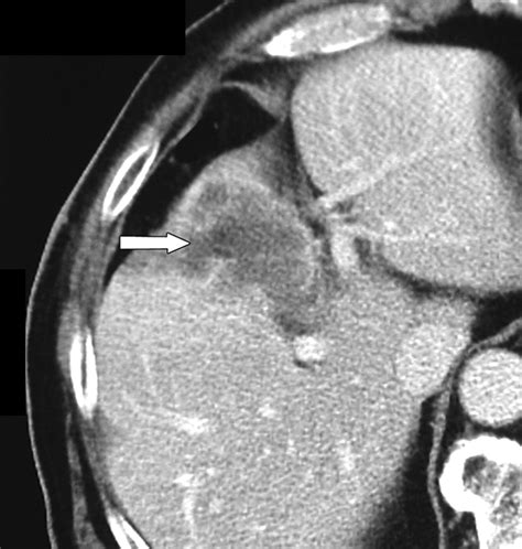 Radiofrequency Ablation Of Hepatic Tumors Adjacent To The Gallbladder