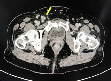 Inguinal Lymph Node Metastasis In Treated Breast Cancer An Extremely Rare Presentation And