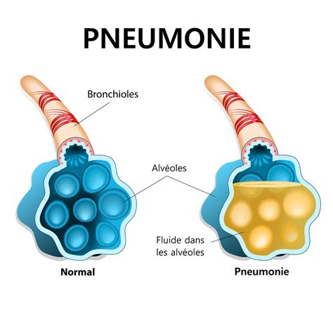 Pneumocoque premiers symptômes transmission et traitements