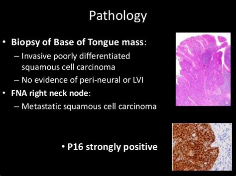 Hpv Base Of Tongue Cancer