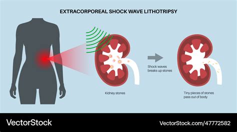 Lithotripsy procedure concept Royalty Free Vector Image