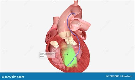 In Alcohol Septal Ablation A Small Amount Of Pure Alcohol Is Released