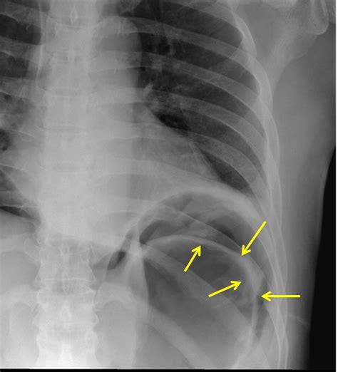 Pneumoperitoneum Rigler Sign Radiology Cases