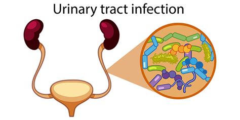 Urinary Tract Infections Types Causes And Treatment Options Gauri Urogynecology Clinic