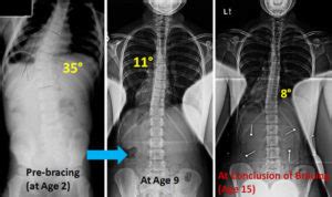 Adolescent Idiopathic Scoliosis Treatment Surgery NJ NYC