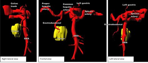 Ct Radiomic Features Of Superior Mesenteric Artery Involvement In