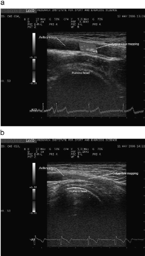 B Mode Ultrasound With Colour Flow Mapping Demonstrating An A Fully