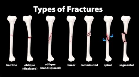 Olahraga Simpel Ini Ampuh Cegah Patah Tulang Dan Osteoporosis