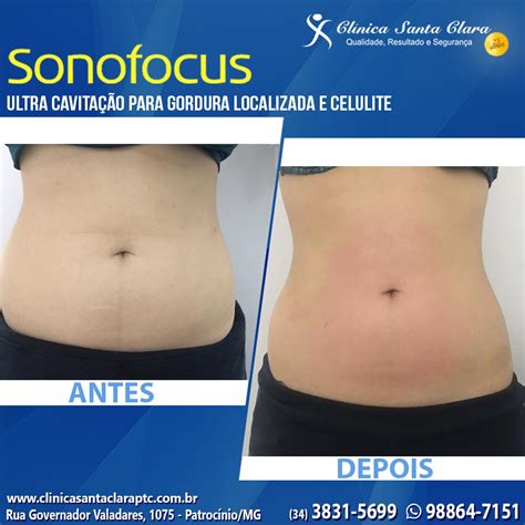 Ultrassom Para Gordura Localizada Antes E Depois
