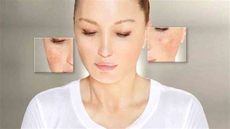 Understanding Rosacea Symptoms Causes And 7 Life Changing Treatment