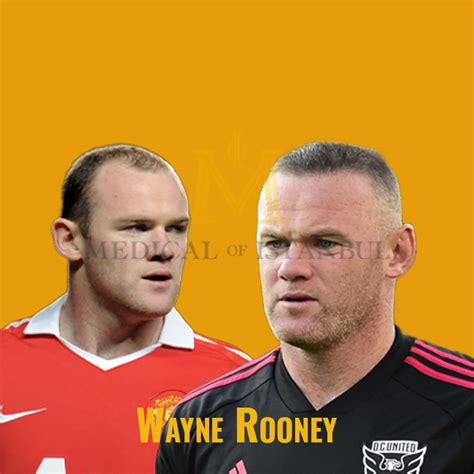 Wayne Rooney Hair Transplant A Journey of Transformation