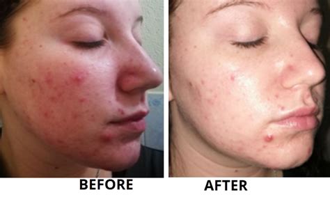 Acne Treatment Skinrx Aesthetic Clinic Pty Ltd