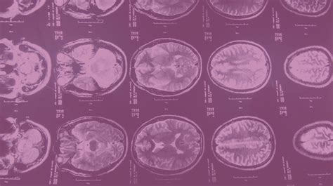 Descripci N De Un Caso De Leucoencefalopat A Multifocal Progresiva Por