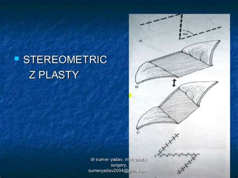scar revision , z plasty