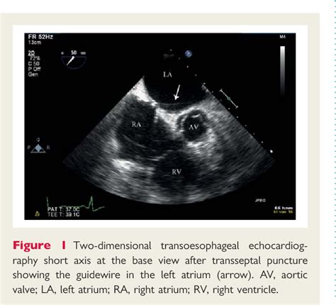 Figure From A Complicated Transseptal Puncture During Mitraclip