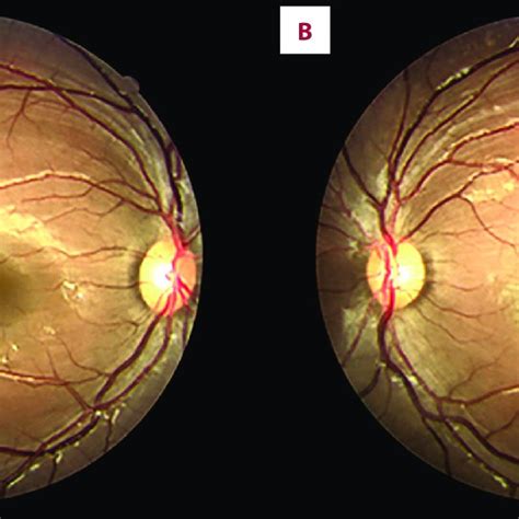 Right And Left Eye Retinographies A Right Eye Fundus Normal B Download Scientific