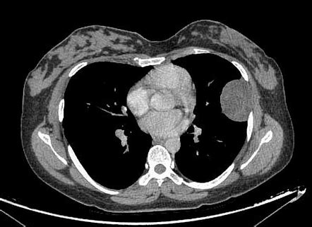 Multiple Schwannomas Image Radiopaedia Org