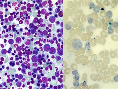 Myelodysplastic Syndrome With Ring Sideroblasts And Multilineage Dysplasia