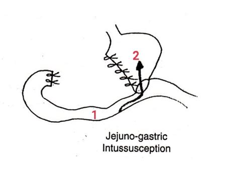 Intussusception Telegraph