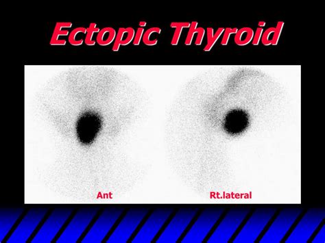 Ppt Thyroid Scan Powerpoint Presentation Free Download Id437897