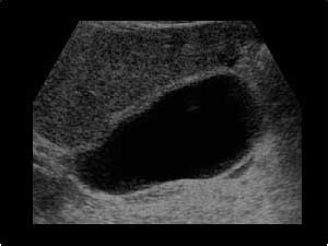 Abdomen and retroperitoneum | 1.1 Liver : Case 1.1.12 Cirrhosis and ...