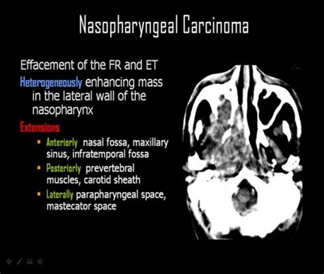 Nasopharyngeal Carcinoma Extensions 2 Eustachian Tube And Fossa