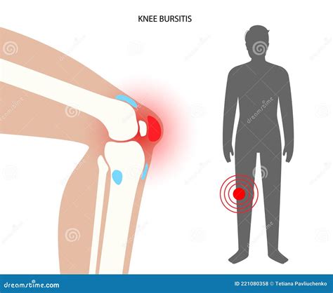 Bursitis Inflammation Concept Stock Vector - Illustration of bursectomy ...