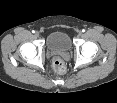 Ct Scan Anus Colon Telegraph