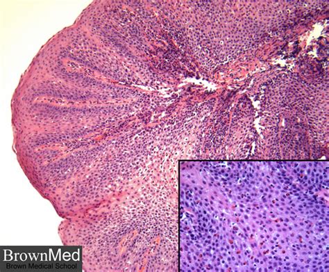 Eosinophilic Esophagitis Histology