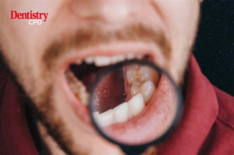 Dentistry Cpd Oral Cancer And The Role Of The General Dental Practitioner