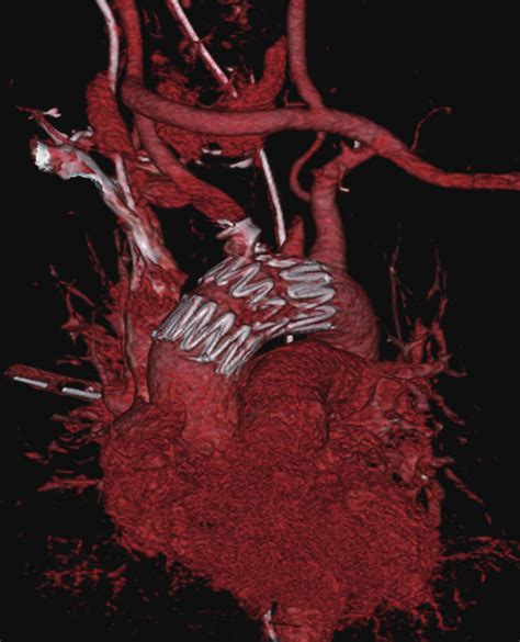 Three Dimensional Reconstruction Of The Postoperative Ct Angiography