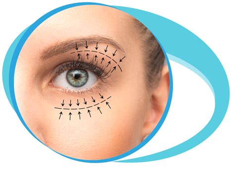 Blepharoplasty In Iran Medpersia Medical Tourism