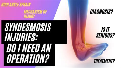 Syndesmosis Injury High Ankle Sprains YouTube