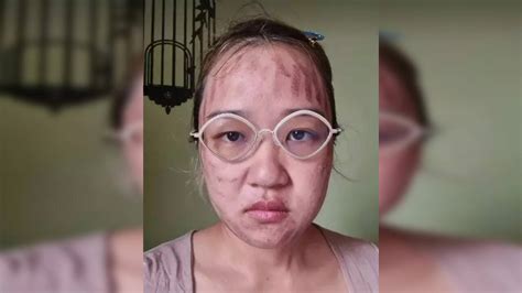 Hot Oil Burn Marks On Face At Alyssa Coode Blog