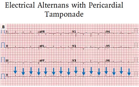 Alternans