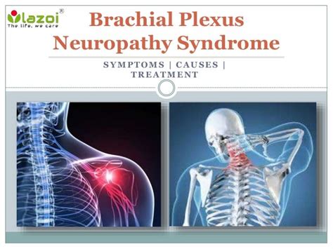 Brachial Plexus Neuropathy Syndrome Causes Symptoms Daignosis And