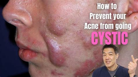 Cystic Acne What Is It Symptoms Causes And Treatment 46 Off