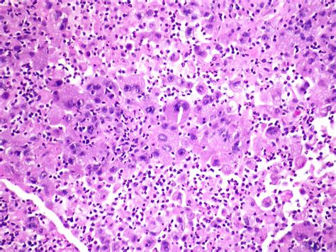 Poorly Differentiated Non Small Cell Carcinoma Nos With A Flickr