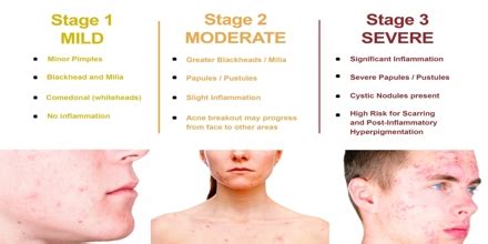 Acne: Skin Diseases - Assignment Point