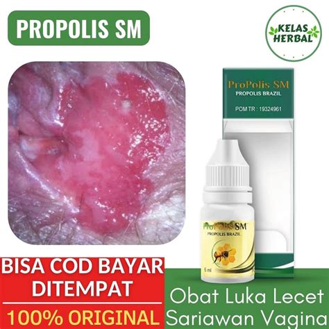 Jual Obat Luka Di Vagina Sariawan Vagina Lecet Perih Ruam Gatal Jamur