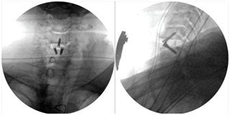 Anterior Cervical Discectomy Fusion Surgery Westmead NSW ACDF