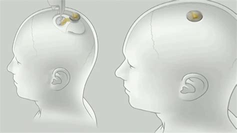 Neuralink Implantiert Erfolgreich Ersten Gehirnchip Bei Menschen