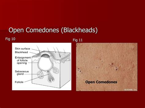 Ppt Acne Disorders Of Sebaceous Gland Powerpoint Presentation Free Download Id1714842