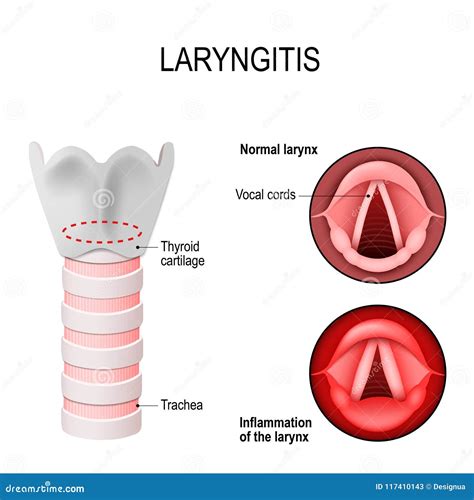 Laryngitis Cartoons, Illustrations & Vector Stock Images - 562 Pictures