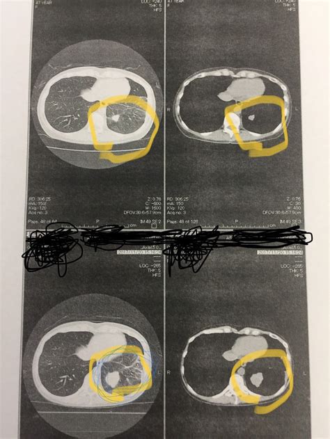 治療前と治療後のct写真 小細胞肺がんと闘った妻の闘病日記と北海道での1人生活