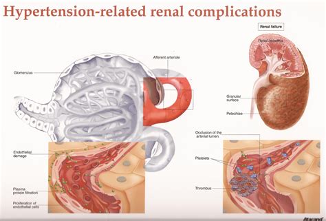 Hypertension - Exploring the Role and Function of the Kidneys