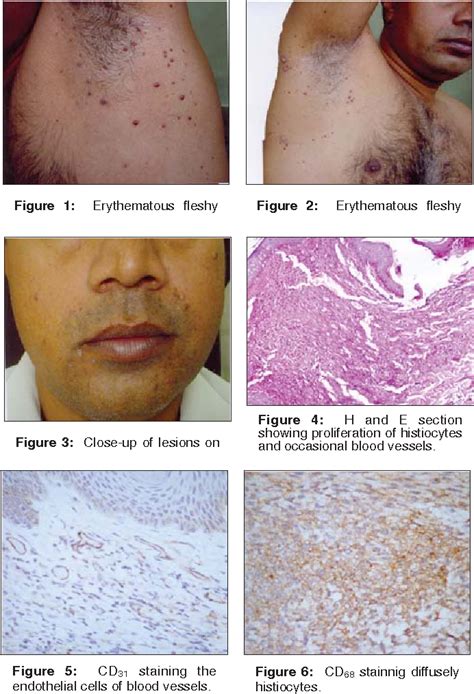 Figure From Generalized Eruptive Histiocytosis Presenting With Warty