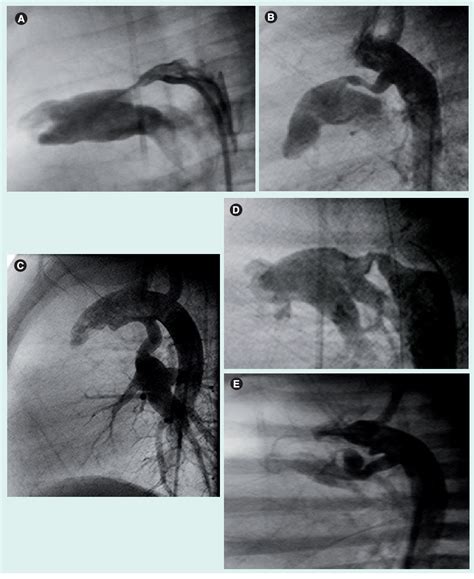 Figure 4 From Stenting The Patent Ductus Arteriosus In Duct Dependent