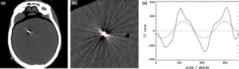 Figure 2 From Determining The Orientation Angle Of Directional Leads For Deep Brain Stimulation