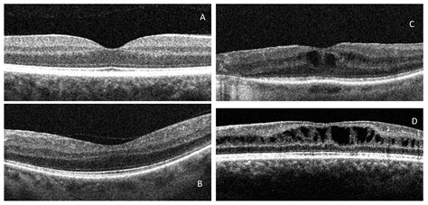 Retinitis Pigmentosa (RP): The Role of Oxidative Stress in the